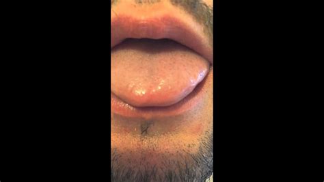Tongue twitches can also occur in benign conditions, quite much more often than in other bad things. . Bfs forum tongue twitching